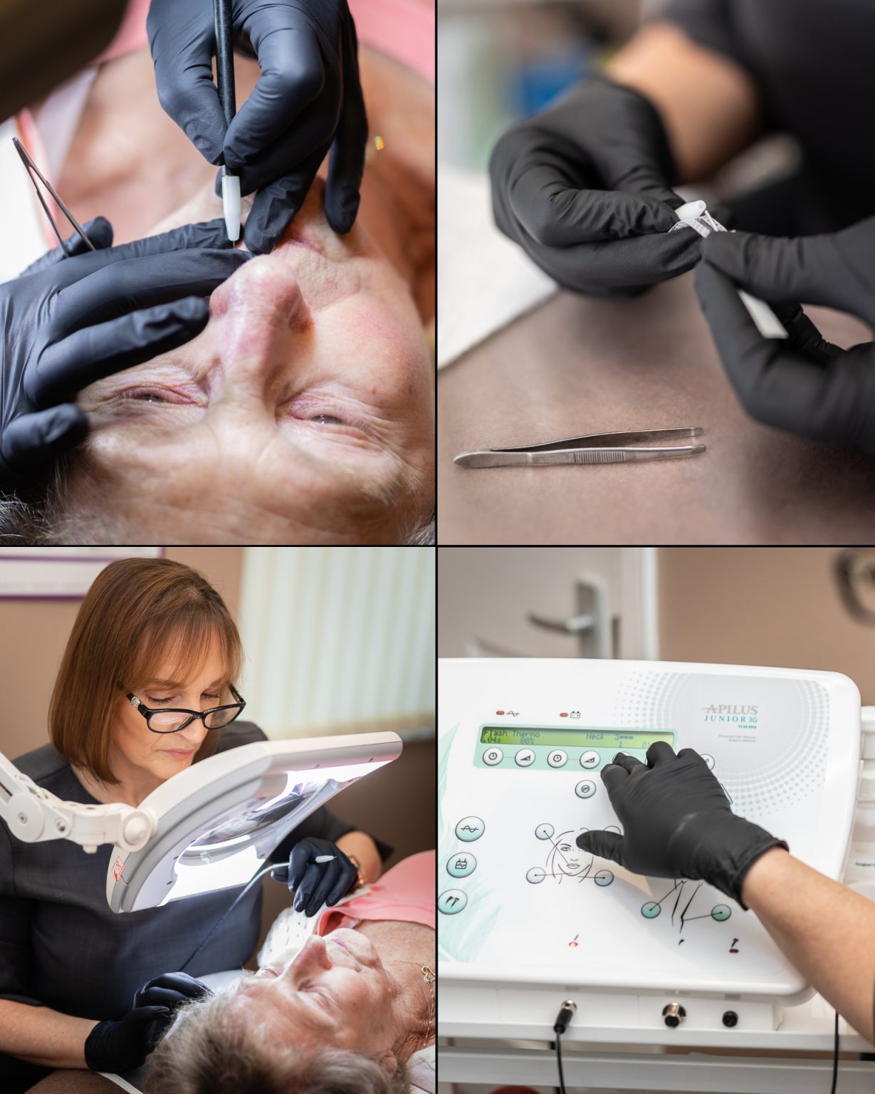 Skin Clinic - Electrolysis Treatment