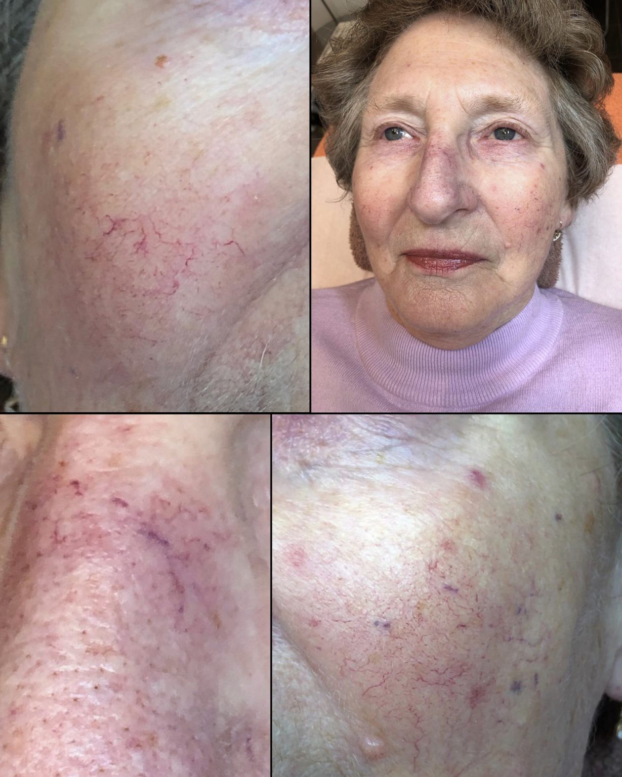 Skin Treatment Before Photos